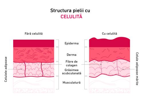 Diagramă care arată structura pielii cu și fără celulită, evidențiind diferențele din epidermă, derm, fibrele de colagen și celulele adipoase.