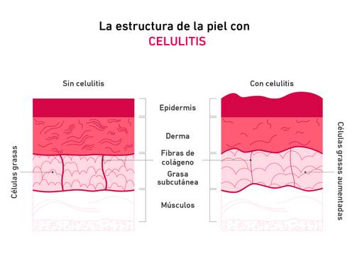 Diagrama que muestra la estructura de la piel con y sin celulitis, destacando las diferencias en la epidermis, la dermis, las fibras de colágeno y las células grasas.