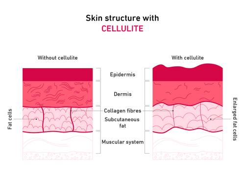 Diagram showing skin structure with and without cellulite, highlighting differences in epidermis, dermis, collagen fibers, and fat cells.