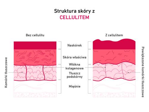Schemat przedstawiający strukturę skóry z cellulitem i bez niego, uwydatniający różnice w naskórku, skórze właściwej, włóknach kolagenowych i komórkach tłuszczowych.