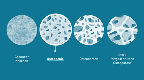 Vier Knochenquerschnitte, die eine zunehmende Porosität zeigen: Gesunder Knochen → Osteopenie → Osteoporose → Fortgeschrittene Osteoporose.