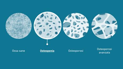 Diagramma che mostra quattro stadi della salute delle ossa: ossa sane, osteopenia, osteoporosi e osteoporosi grave, con porosità crescente.
