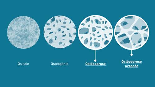 Illustration montrant la progression de la densité osseuse : os sain, ostéopénie, ostéoporose et ostéoporose sévère, avec augmentation de la porosité.