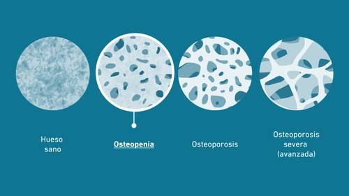 Diagrama que muestra las cuatro etapas de la salud ósea: hueso sano, osteopenia, osteoporosis y osteoporosis grave, con aumento progresivo de la porosidad.